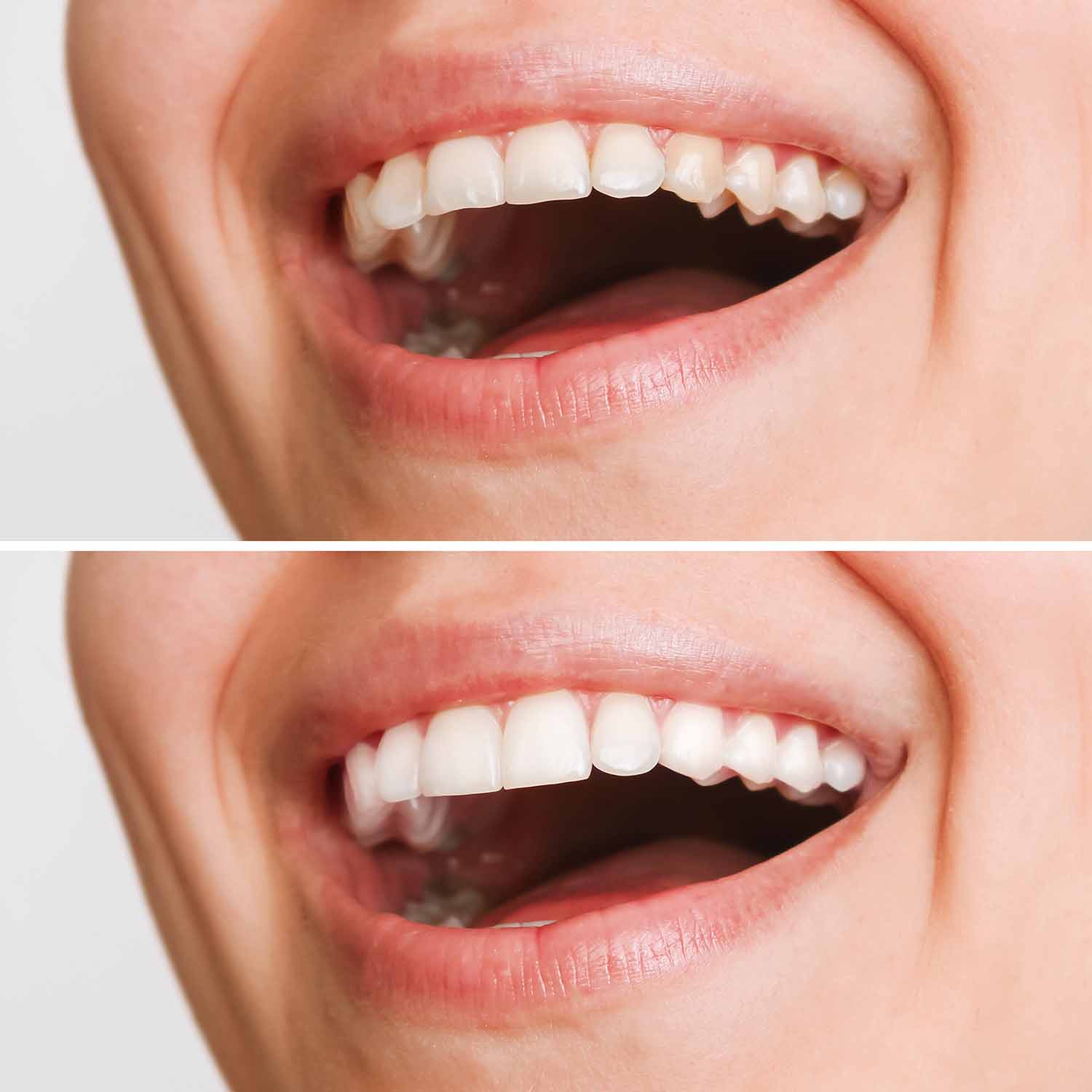 Veneers vs Crowns Which Dental Treatment is Best for You?